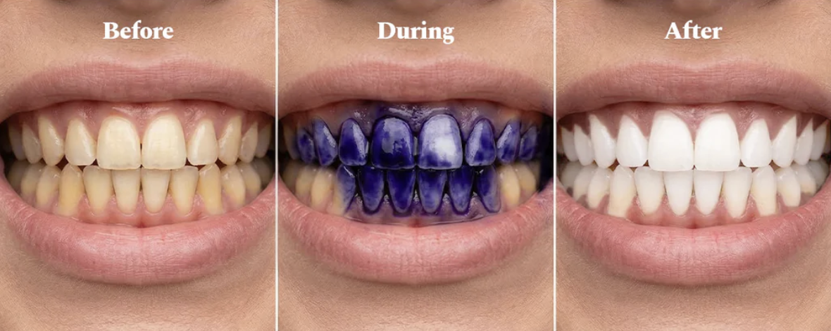 Teeth before application look yellow, during application are coated in purple serum, and after look visibly brighter.